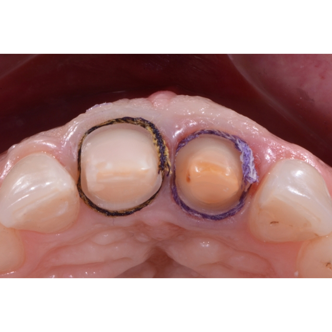 Sure Endo Sure Cord Knitted Retraction Cord #00