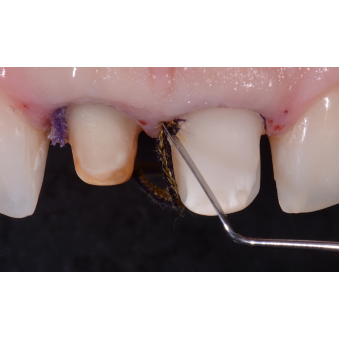 Sure Endo Sure Cord Knitted Retraction Cord #00