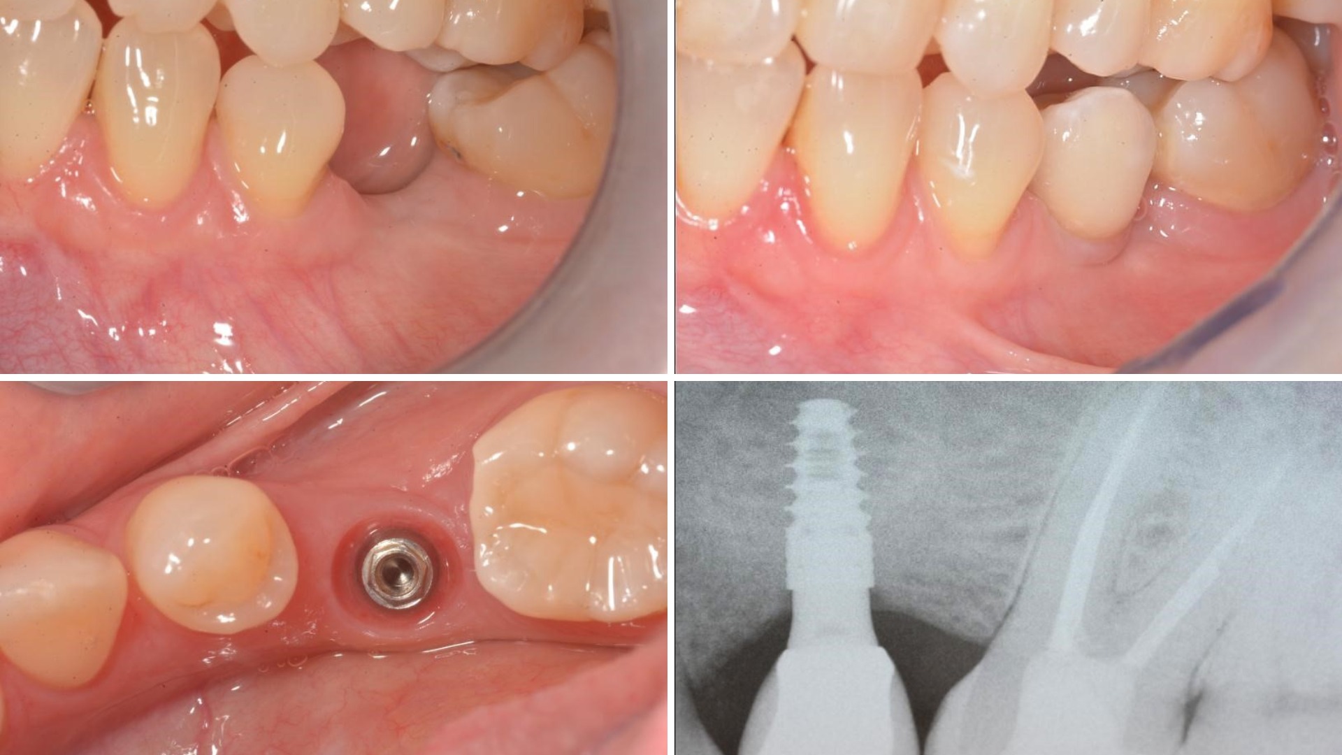 Impact Compressive Sharp Tip Dental Implant 4.20 mm
