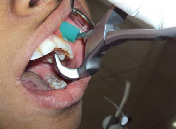 Waldent Physics Forceps Set of 2 K1/4 