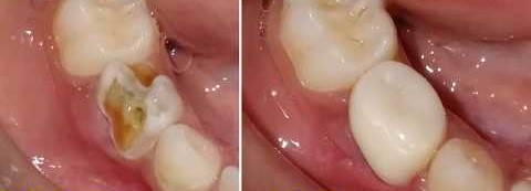 Kids-e-Crown Zirconia Lower Right 1st Molar Refills