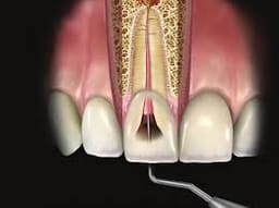 Waldent Root Canal Pluggers - 10