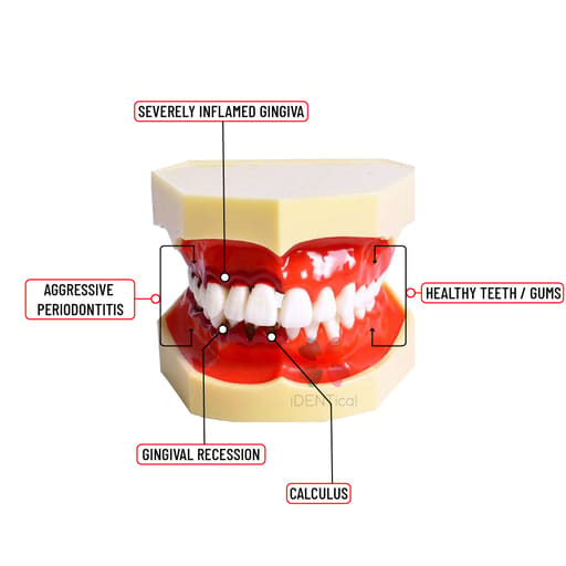iDENTical Periodontal Disease Model M4025