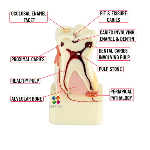 iDENTical 4X Pathologies Of Tooth Model - M4015