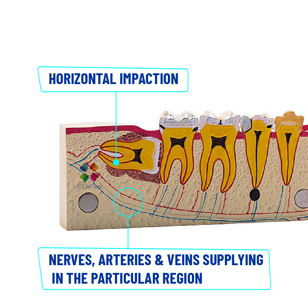 iDENTical Third molar Impaction Teeth Model M4009