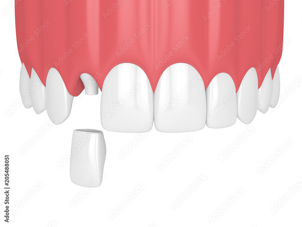Kids-e-Dental BioFlx Lateral Incisor Crowns Refills
