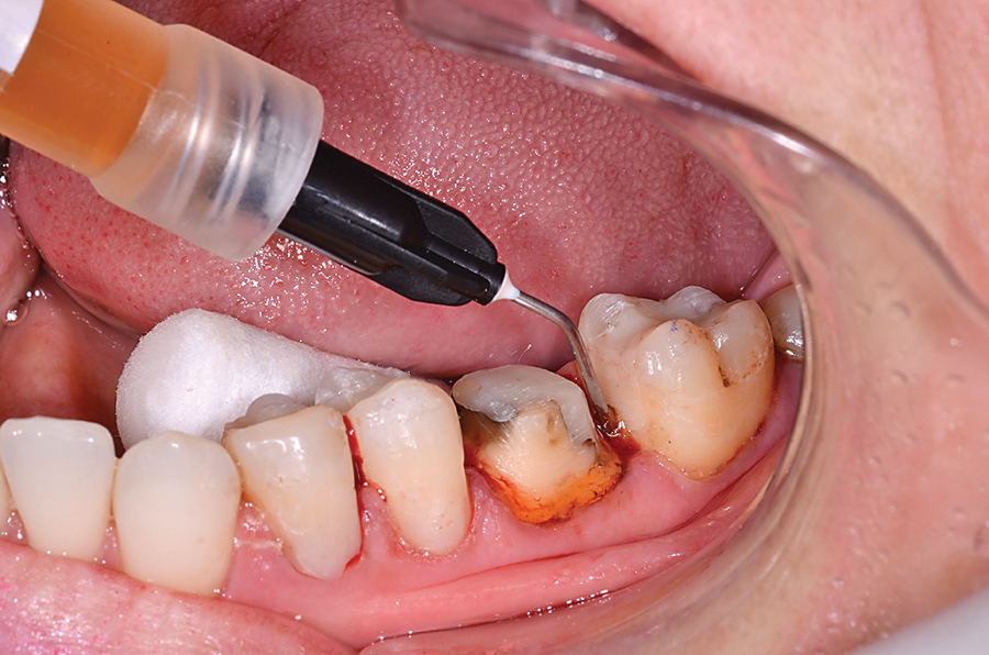 SafeEndo Smart Retract Syringe