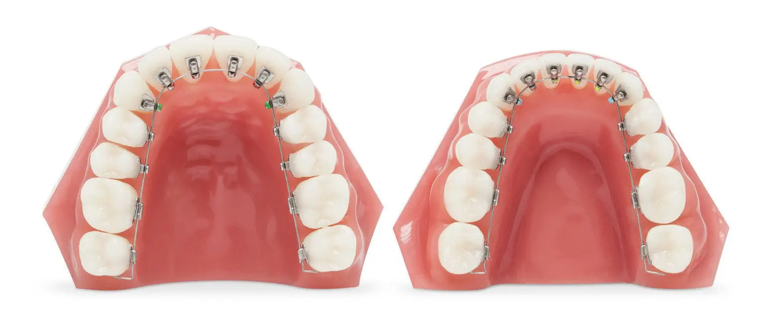 U Ortho Lingual Brackets 018