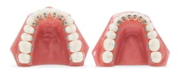 U Ortho Lingual Brackets 018 - 6