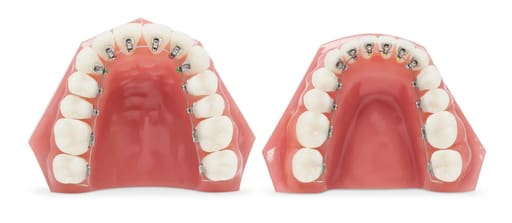U Ortho Lingual Brackets 018