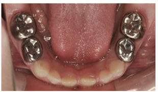 3M ESPE Stainless Steel Primary Crown E( 2nd Molar)