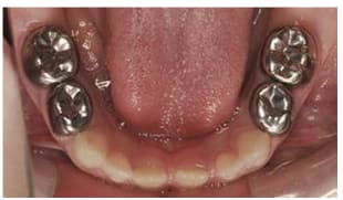 3M ESPE Stainless Steel Primary Crown E( 2nd Molar)