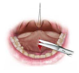 Waldent Surgical Scissors - Micro Iris - 12