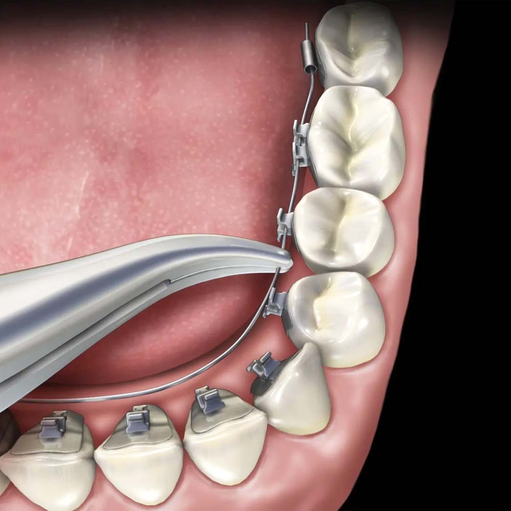 Waldent Weingart Plier TC 10/105