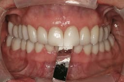 Bausch Dental Arti Fol Metallic Shimstock Flim 12µ Microns - 10