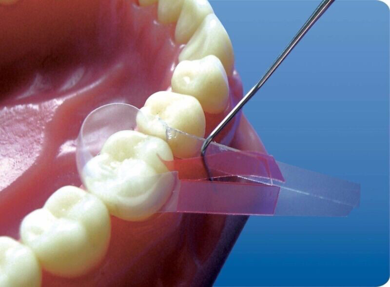 Tor Vm Transparent Contoured Matrices for Premolars & Molars