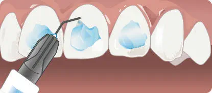 D-Tech Embrace LC Orthodontic Bonding Kit