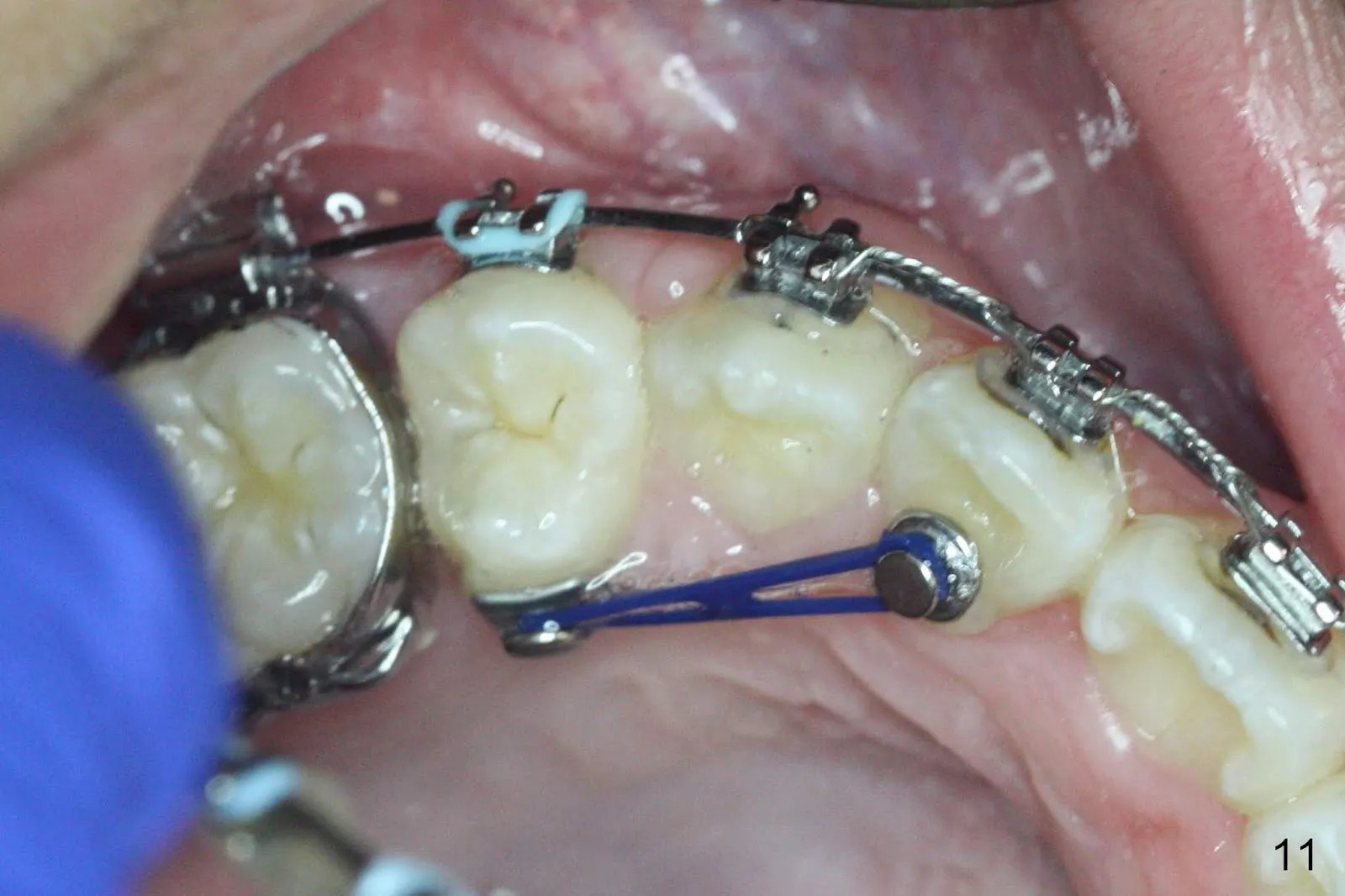 U Ortho Bondable Lingual Buttons Round (10/pk)