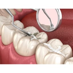 Prime Dental Prime Cem Ceramic Reinforced Glass Ionomer Cement       - 4