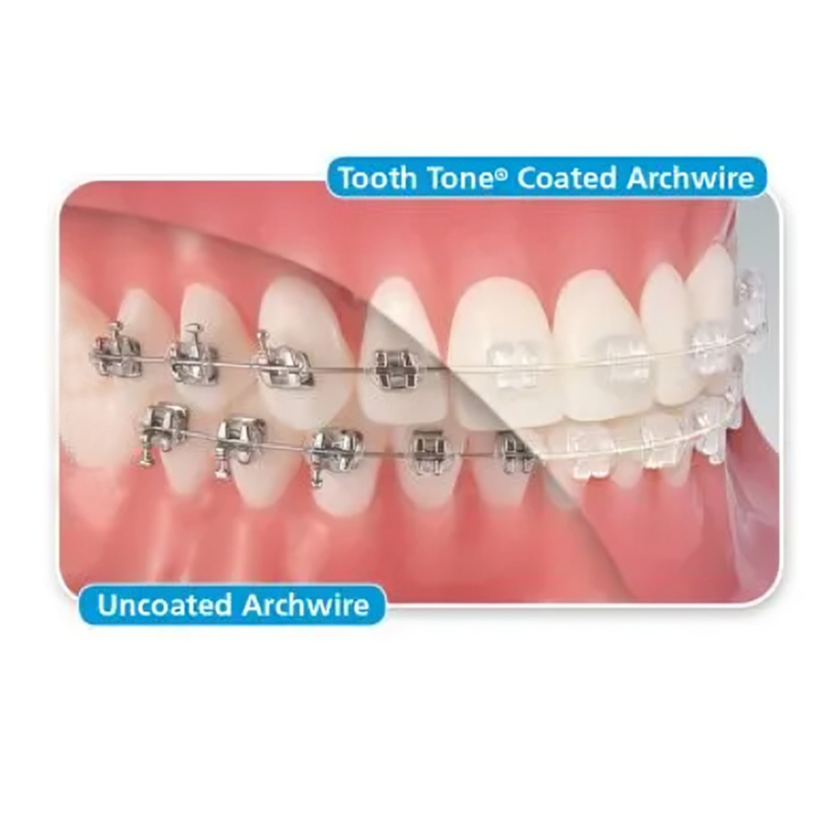 OSL NiTi Tooth Color Ovoid Form Archwires - Rectangular (Pack Of 5)