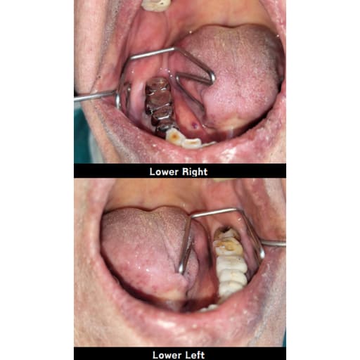 HN Dental Iso-Guard