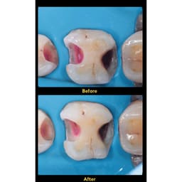 HN Dental Iso-Guard - 3