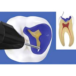 Prime Dental Restorite Cal 2gm - 4