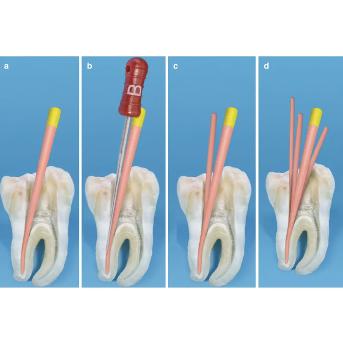 Waldent Finger Spreaders 21mm # 15-40 (Pack of 6)