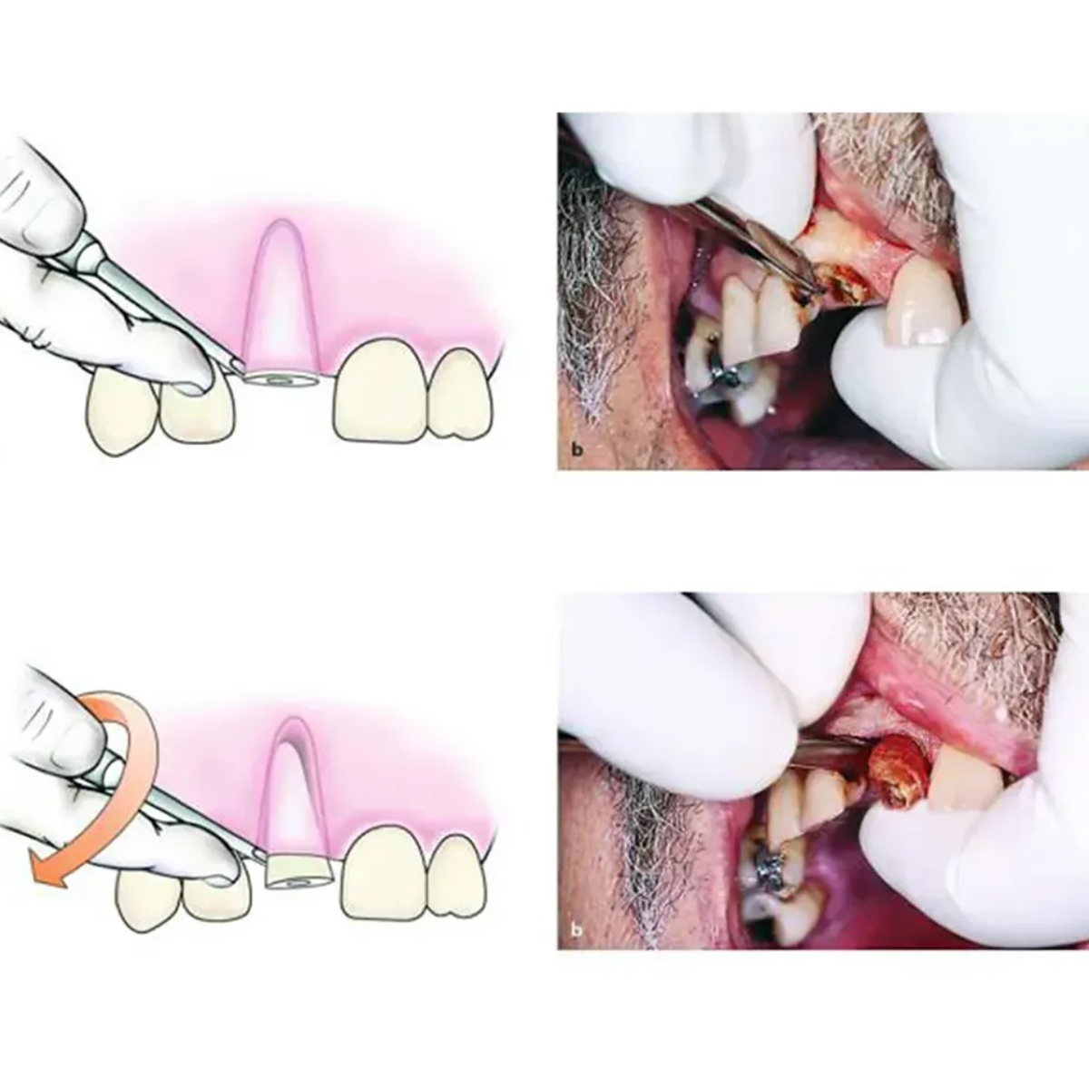 Waldent Seldin Root Elevator (2/133)