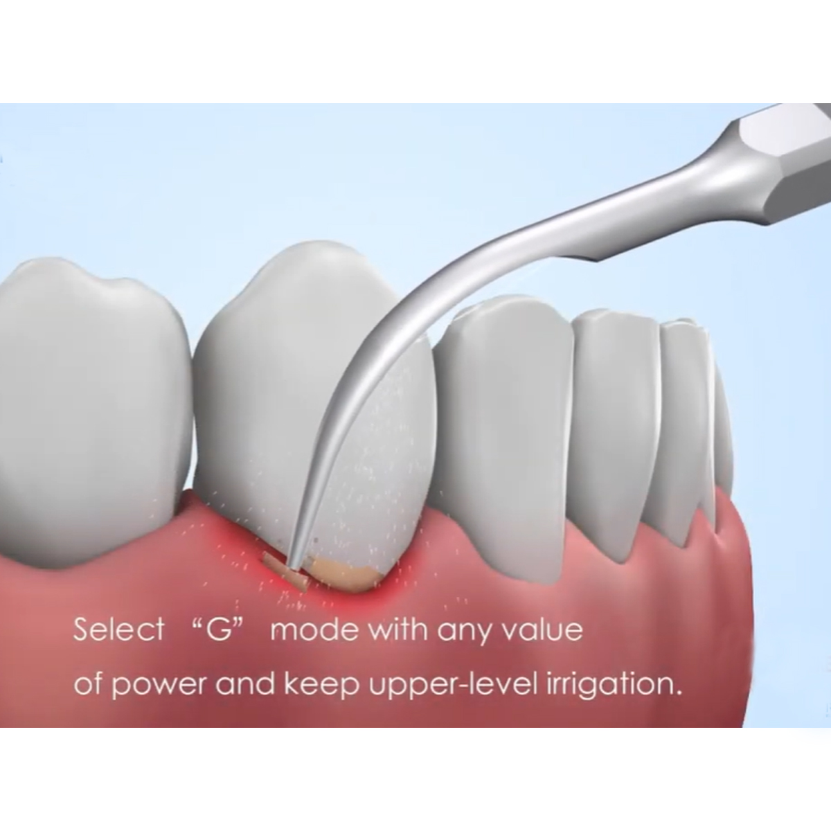 Woodpecker Scaler Tip GD5 for DTE & Satelec Scalers