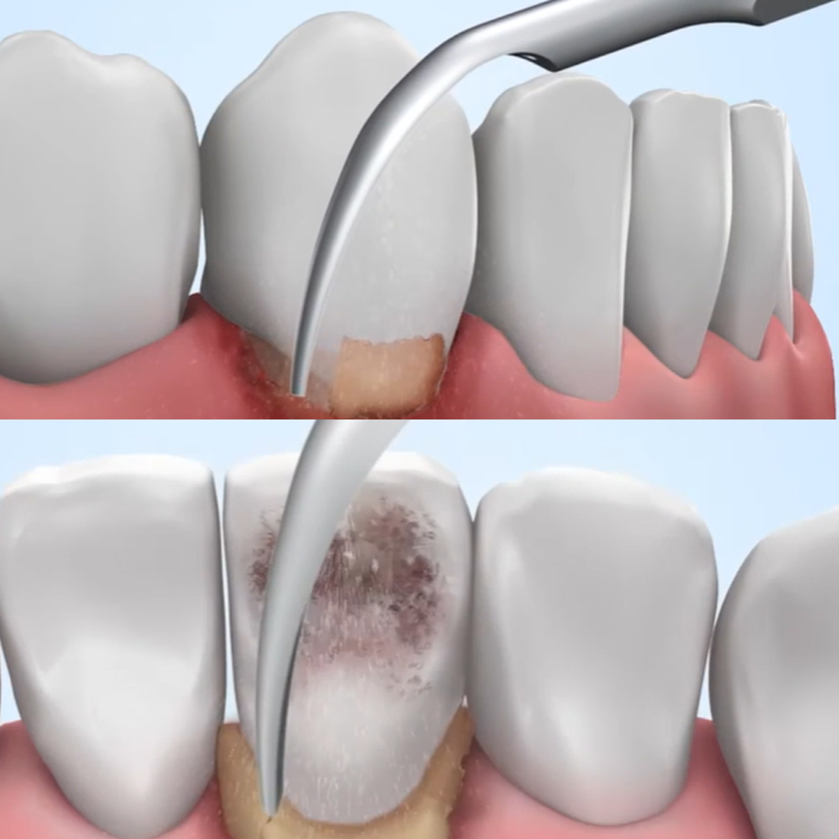 Woodpecker Scaler Tip G1 for UDS & EMS Scalers