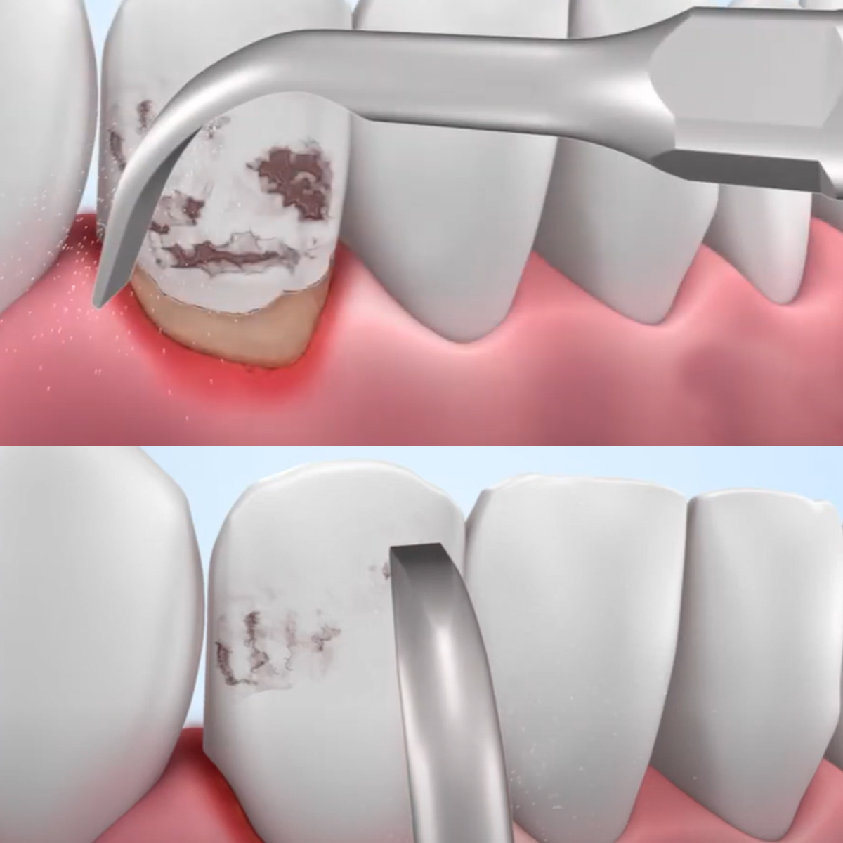 Woodpecker Scaler Tip G2 for UDS & EMS Scalers