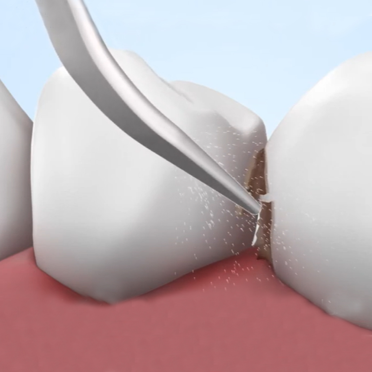 Woodpecker Scaler Tip G3 for UDS & EMS Scalers