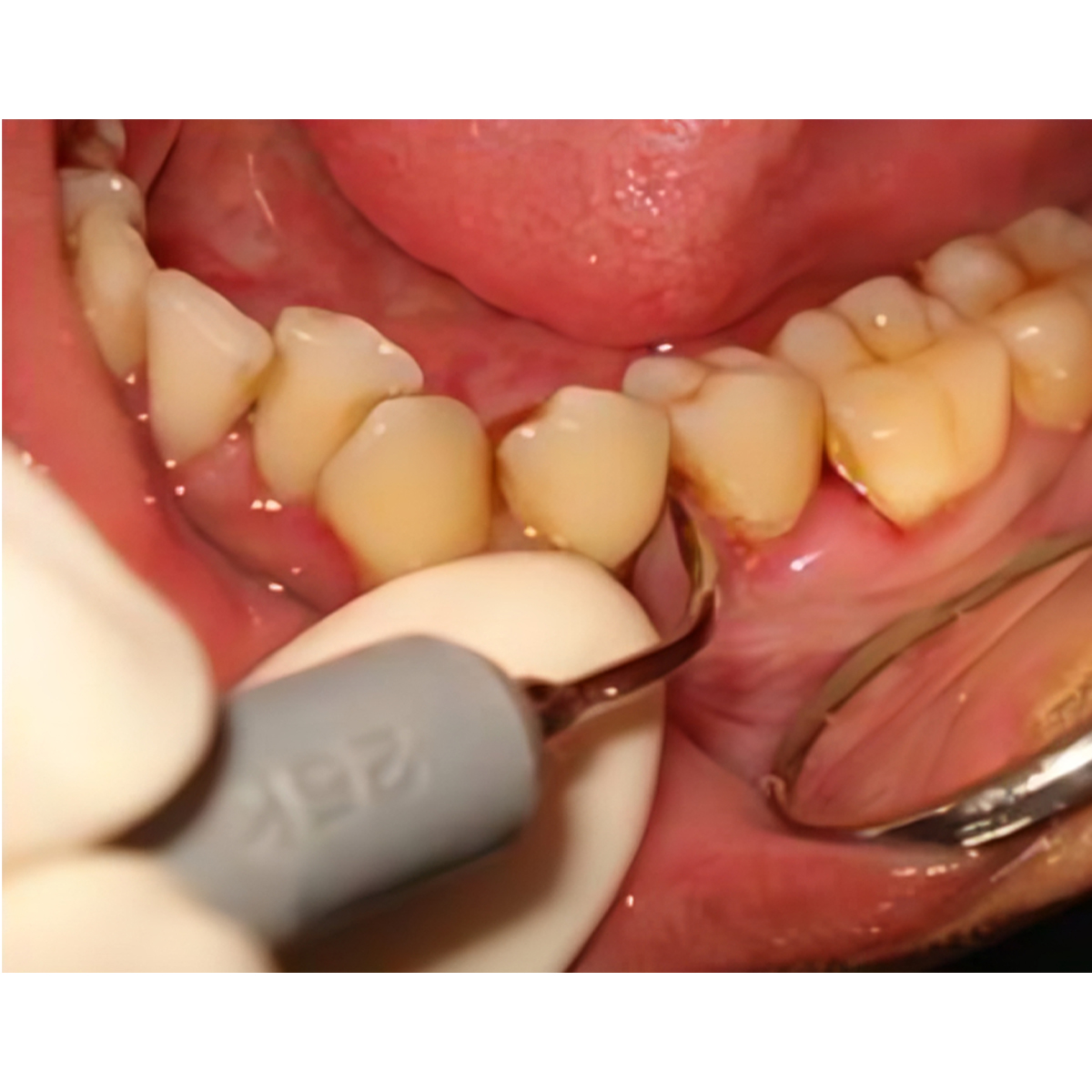 Woodpecker Scaler Tip G3 for UDS & EMS Scalers