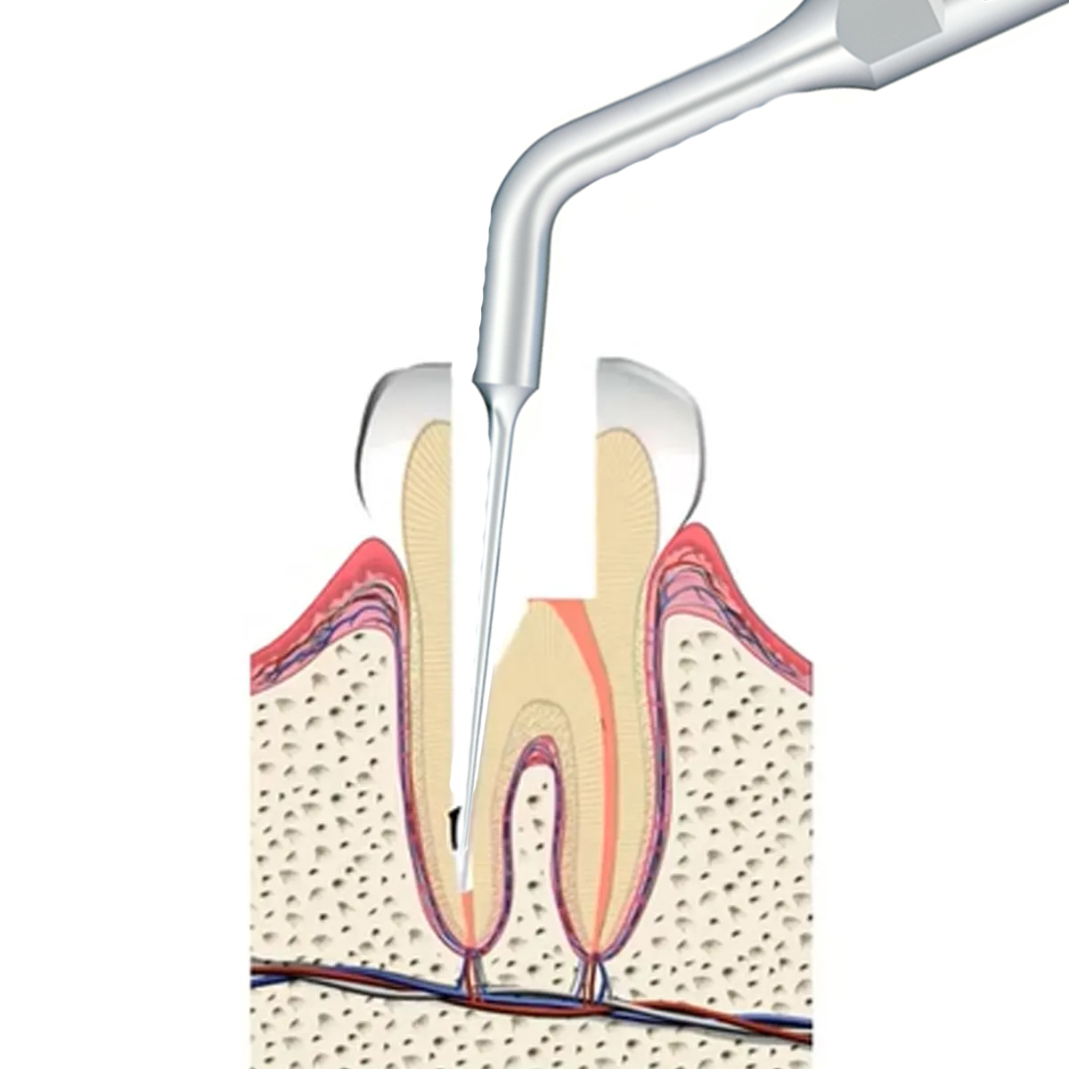 Woodpecker Scaler Tip E7 for UDS & EMS Scalers