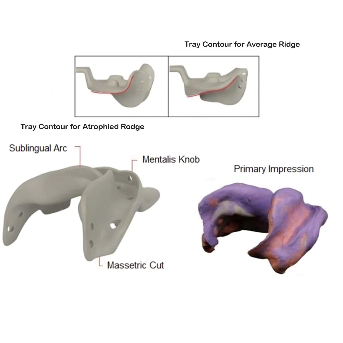 Delta Xtend Trays For Edentulous Impression Professional Set ( Set of 14)