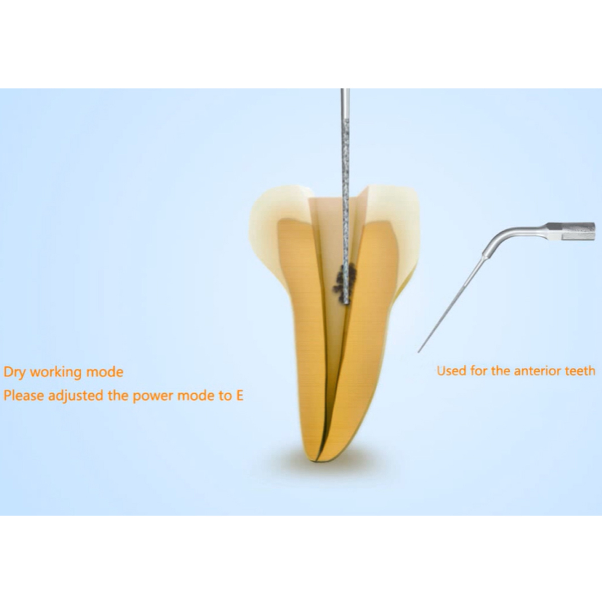 Woodpecker Scaler Tip ED4D for DTE & Satelec Scalers
