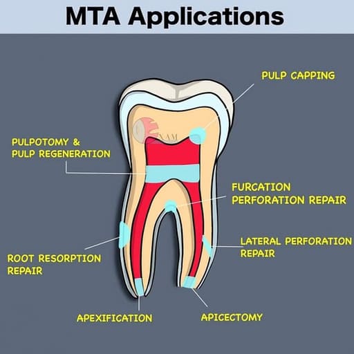Prime Dental Prime MTA Packable