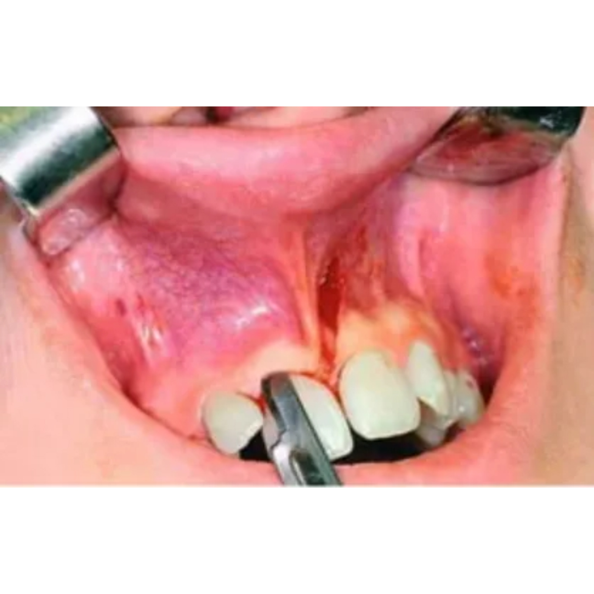 RMC Sterile BP Surgical Blade Size #15 (Pack of 100)