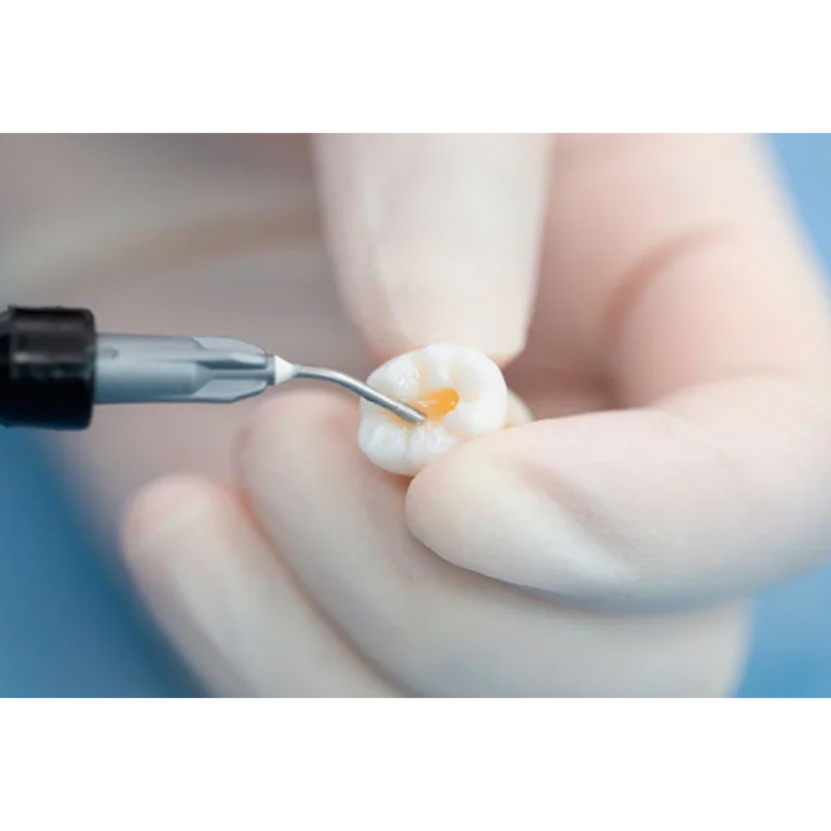 DPI Curex Flow Lightcure Flowable Restorative Composite Refills