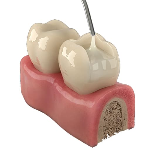 Wizdent Master Design Restorative Composite Refills