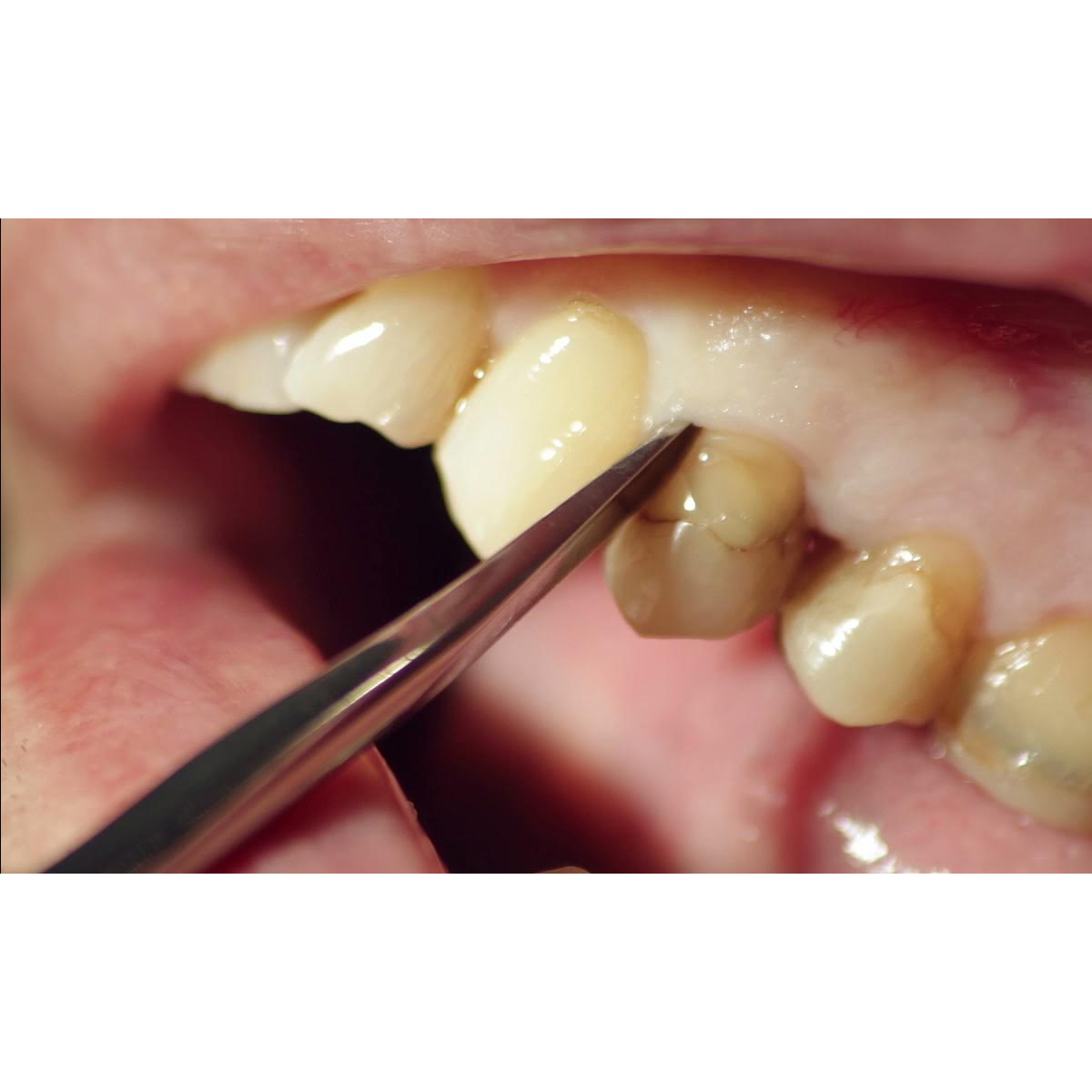 LM-SlimLift Luxating Instruments For Narrow Areas