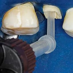Wizdent Wonder Edge DC Core & Resin Cement Refills - 3