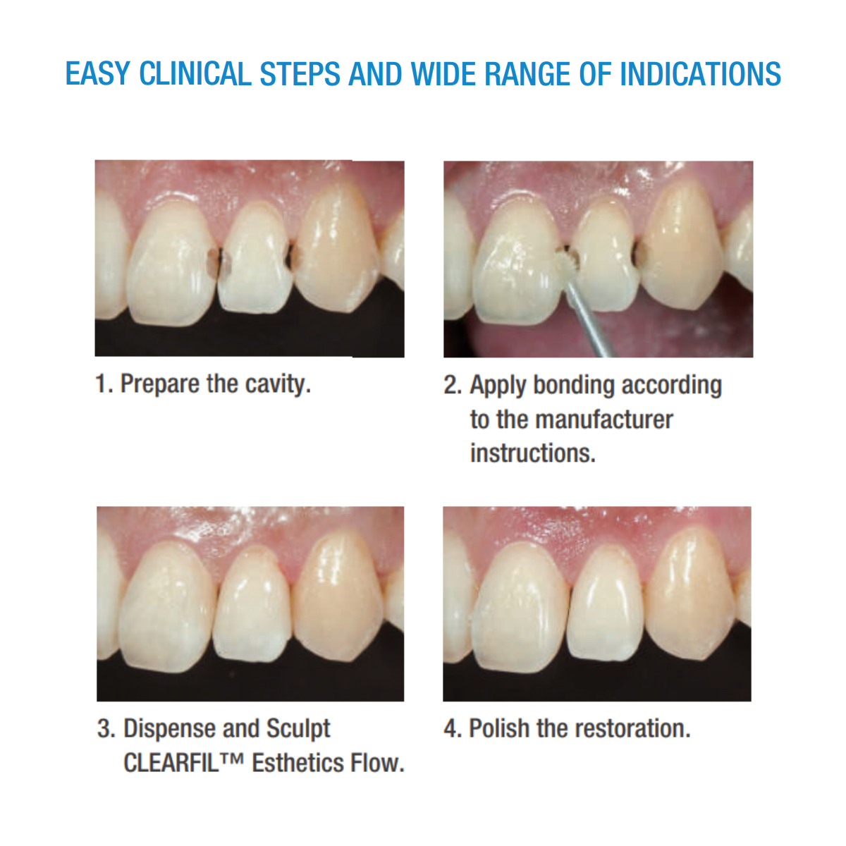 Kuraray Clearfil AP-X Esthetic Flow Flowable Composite Refills