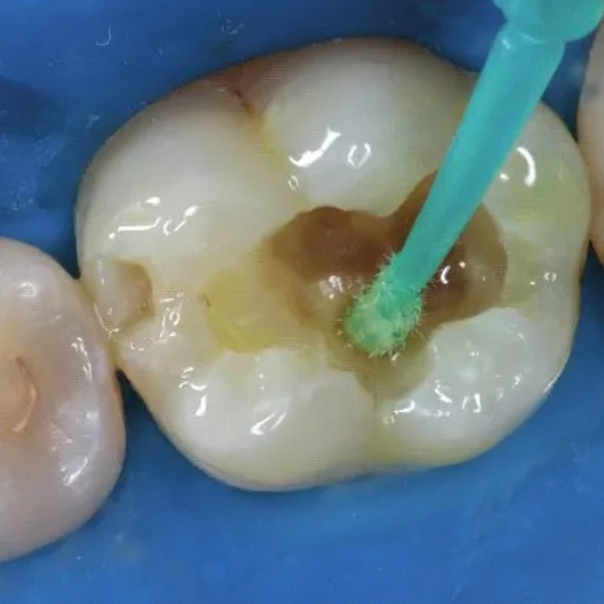 Kuraray Clearfil SE Bond Introductory Kit