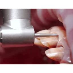 Waldent Crown & Bridge Tooth Preparation Diamond Bur Kit (Set of 14) - 13