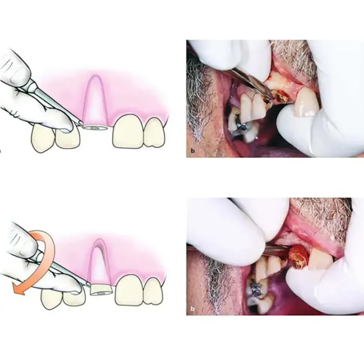 Waldent Root Elevators Heidbrink Thumb Handle