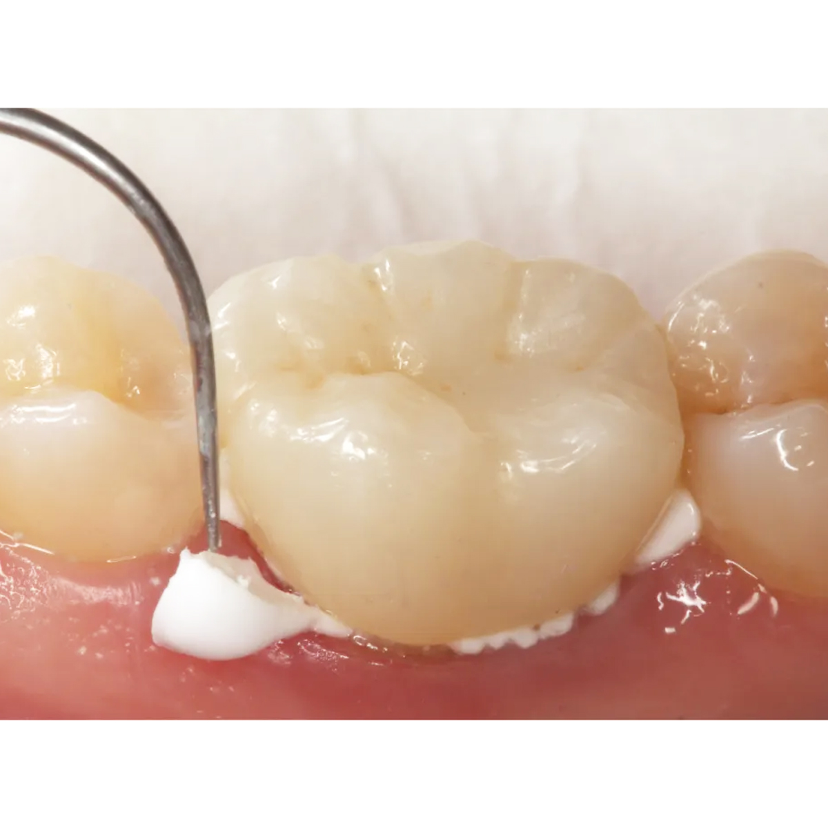 DPI LuteCem Radiopaque Glass Ionomer Luting & Lining Cement