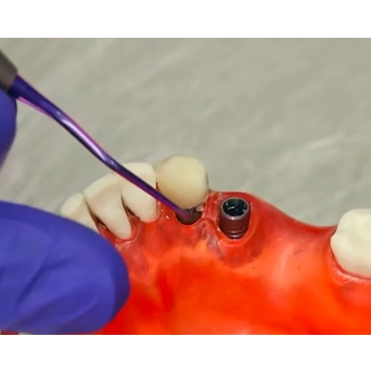 GDC Titanium Implant Mini Curette - IMSAS1/2