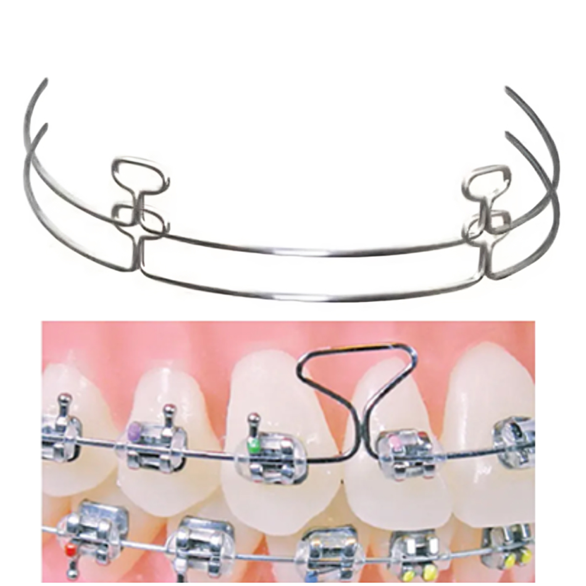 OSL Stainless Steel T-Loop Archwires (Pack Of 10)